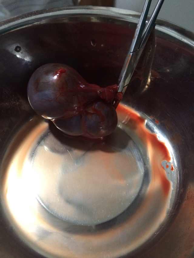 ר������ȡ"ը��"ʮ�겡ʹһ����